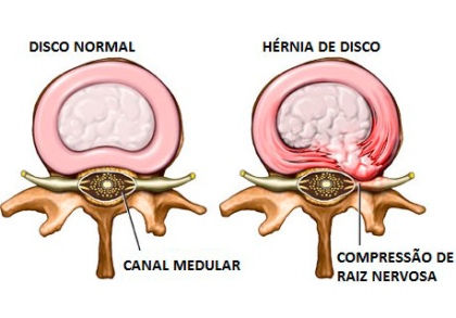 Fases da Hérnia de Disco - Conheça os Estágios da Herniação Discal